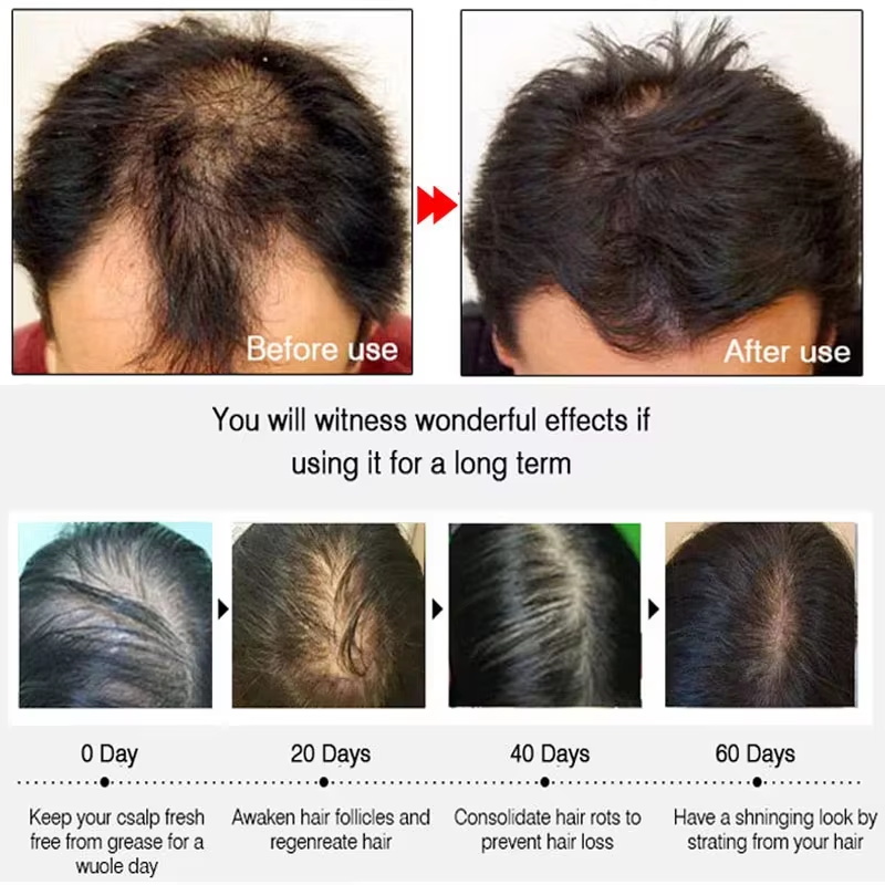 速効性ジンジャーヘアグローススプレー、毛根育成、脱毛防止、育 - Hair Care Hair Serum のレビューと価格